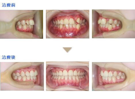 症例集 会田矯正歯科 川越市 歯の矯正費用でお悩みの方へ