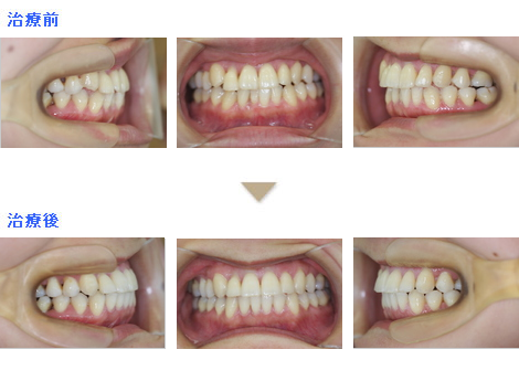症例集 会田矯正歯科 川越市 歯の矯正費用でお悩みの方へ